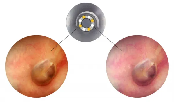 LuxaScope Auris CCT LED Otoskop 2,5 V Blau
