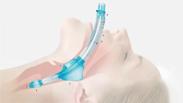 VBM LT®evo – Larynxtubus mit farbcodierter Spritze Gr. 4 für Erwachsene 50-90 kg