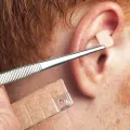 Dongbang Press Needles  0,2 x 2 x 1,0 mm, Ohr-Dauernadeln (100 Stück)